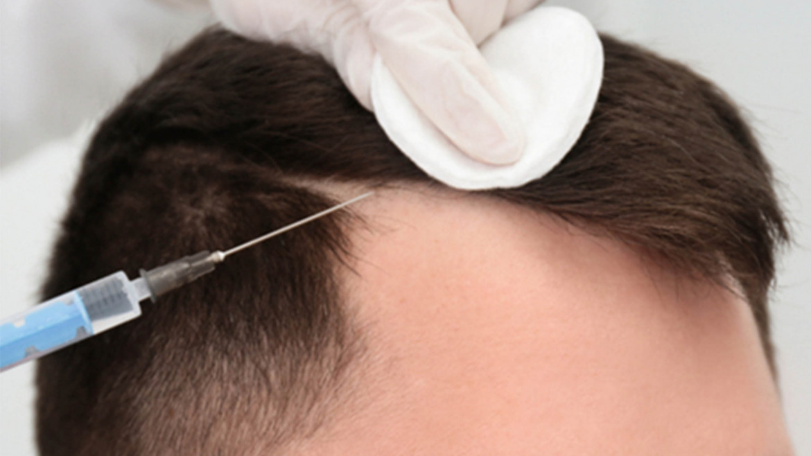 Stem Cell Hair Restoration